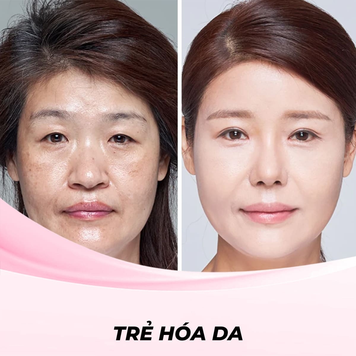 Trẻ Hóa Da Bằng Công nghệ HIFU - Trải Nghiệm 1 Buổi