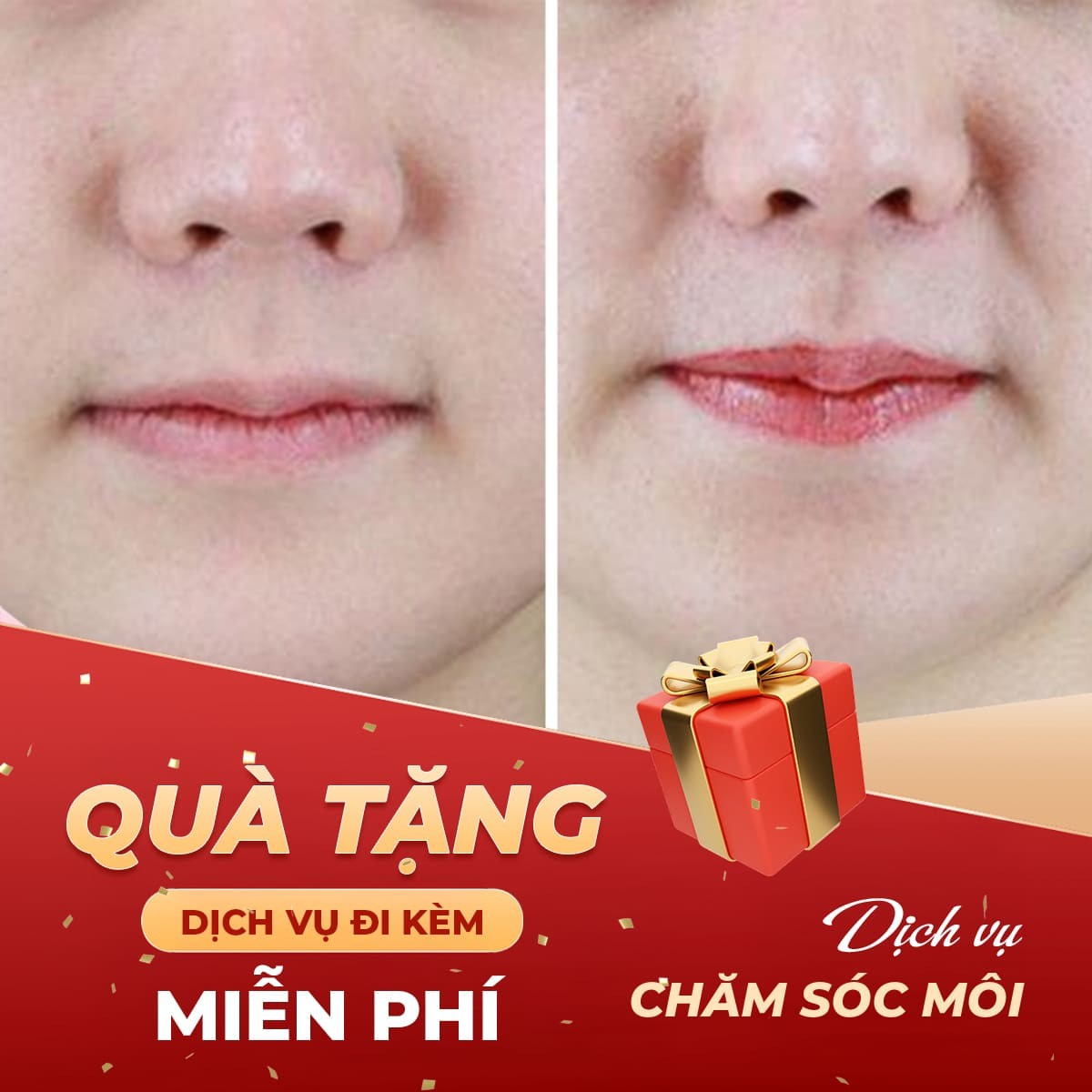 Tặng 1 dịch vụ khi sử dụng dịch vụ làm đầy môi bằng filler