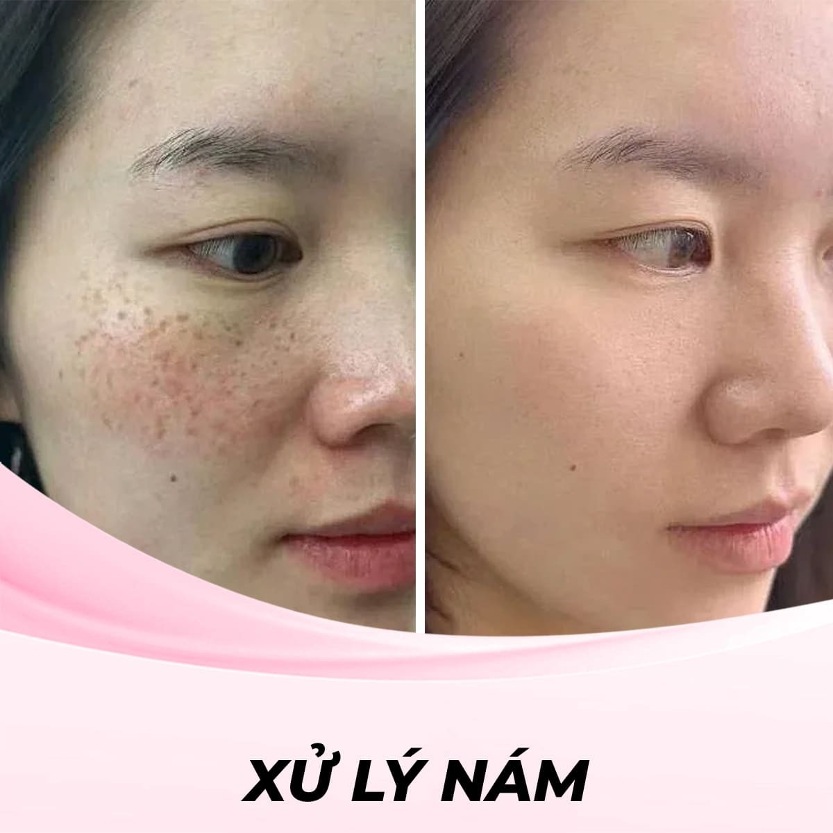Xử lý  nám bằng công nghệ Laser Toning