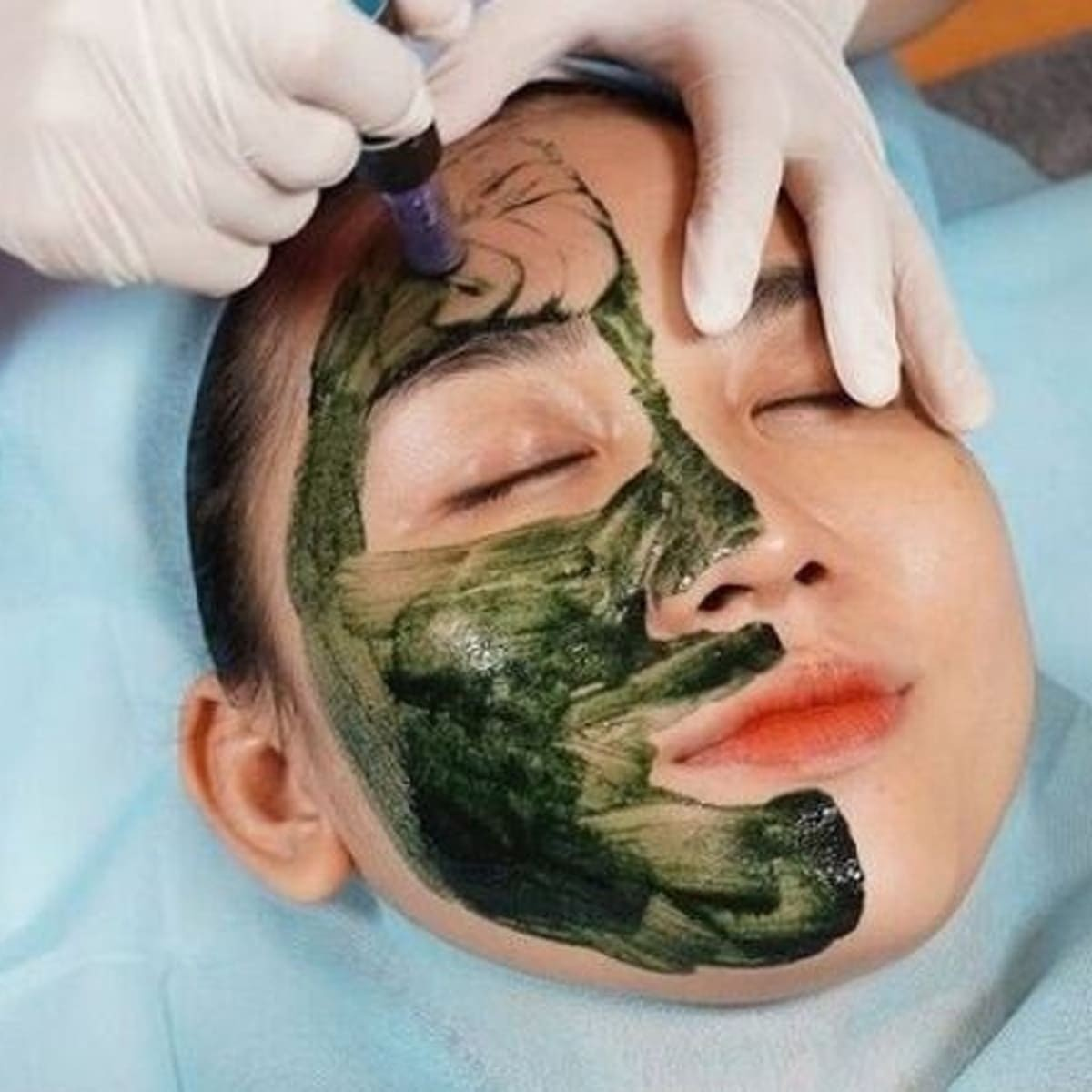 Khuyến Mãi Giảm Giá Dịch Vụ Xử Lý Bớt Sắc Tố Bằng Vi Kim Tảo Biển