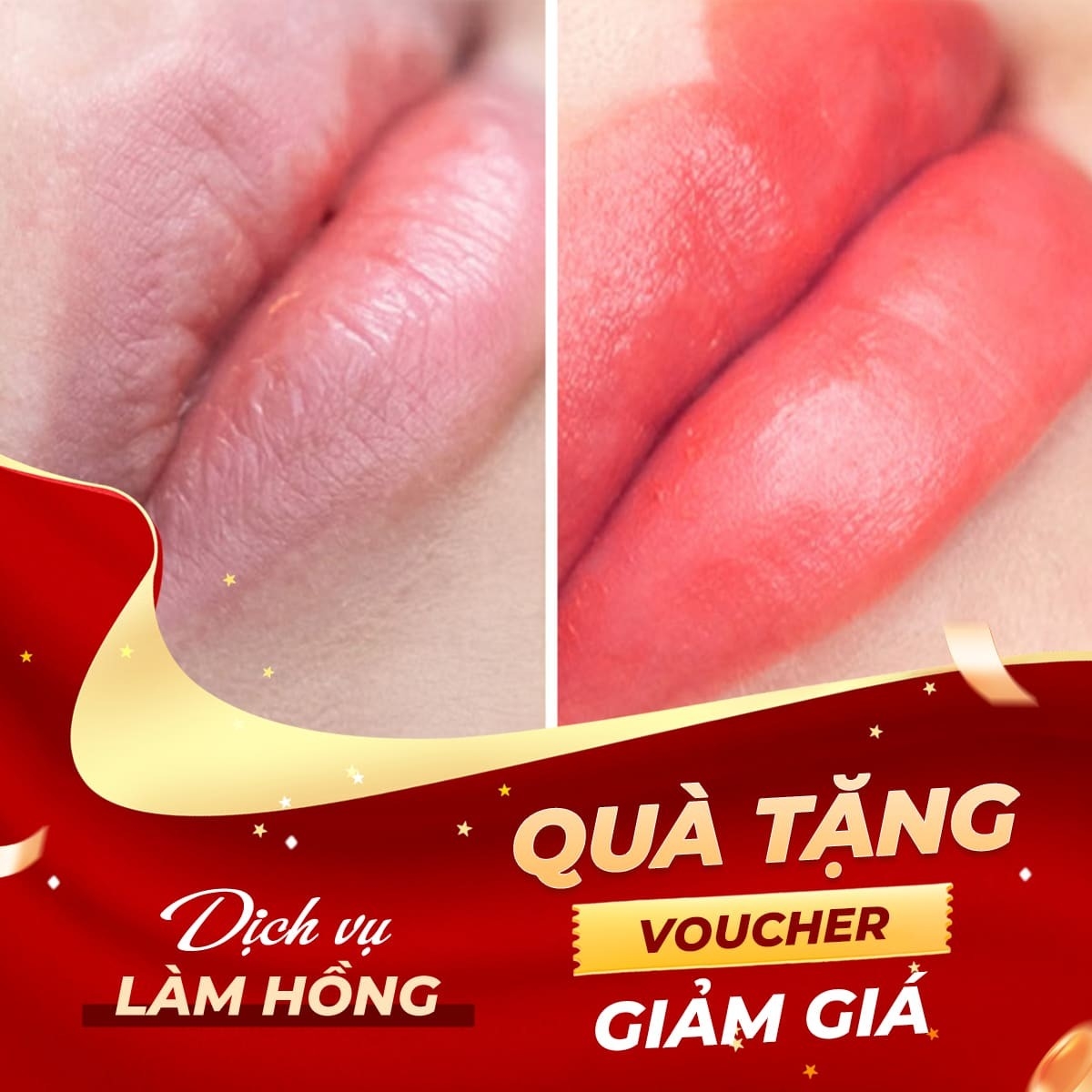 Tặng voucher dịch vụ liệu trình làm hồng môi bằng vitamin C