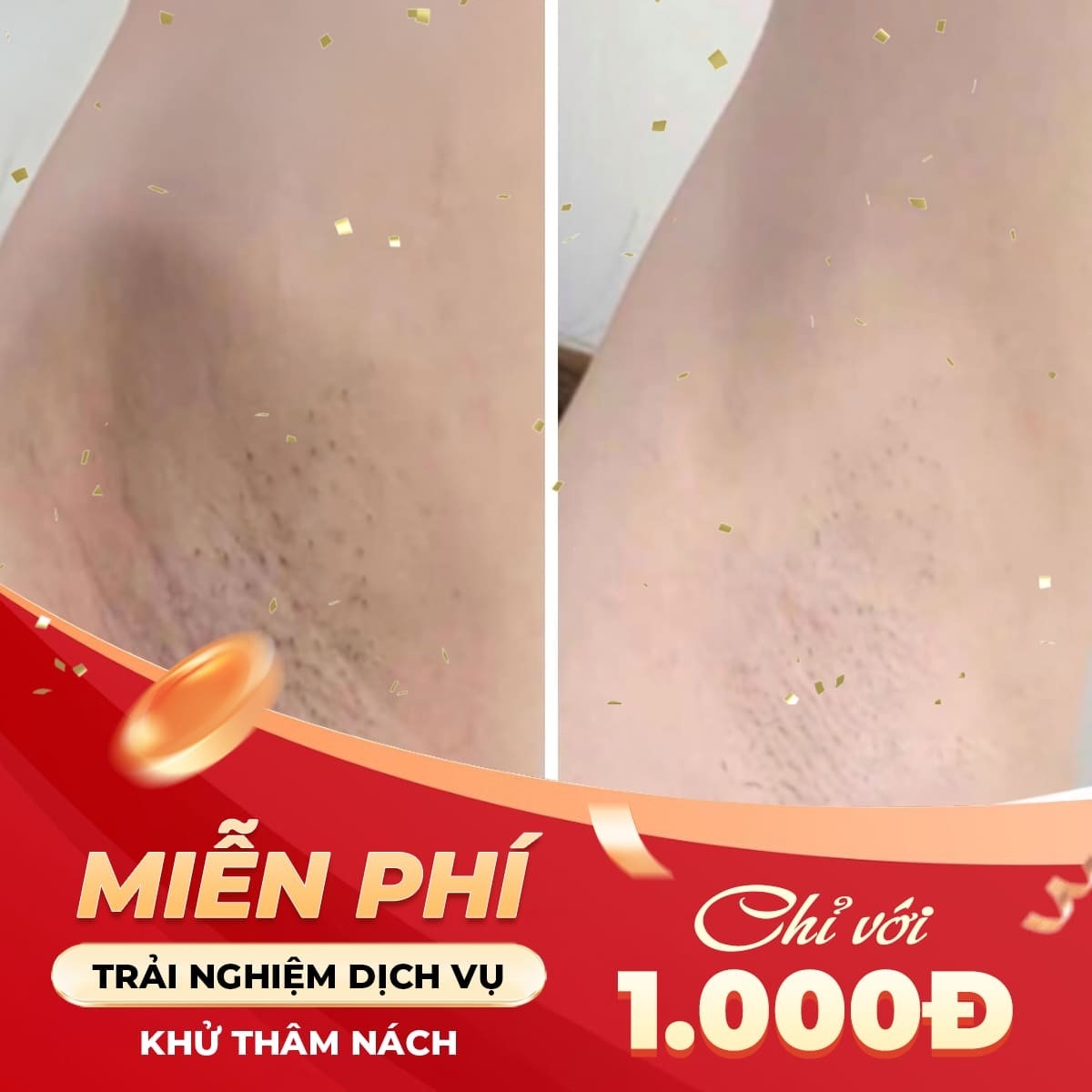 Tặng 1 dịch vụ khi sử dụng dịch vụ khử thâm nách bằng phương pháp Laser