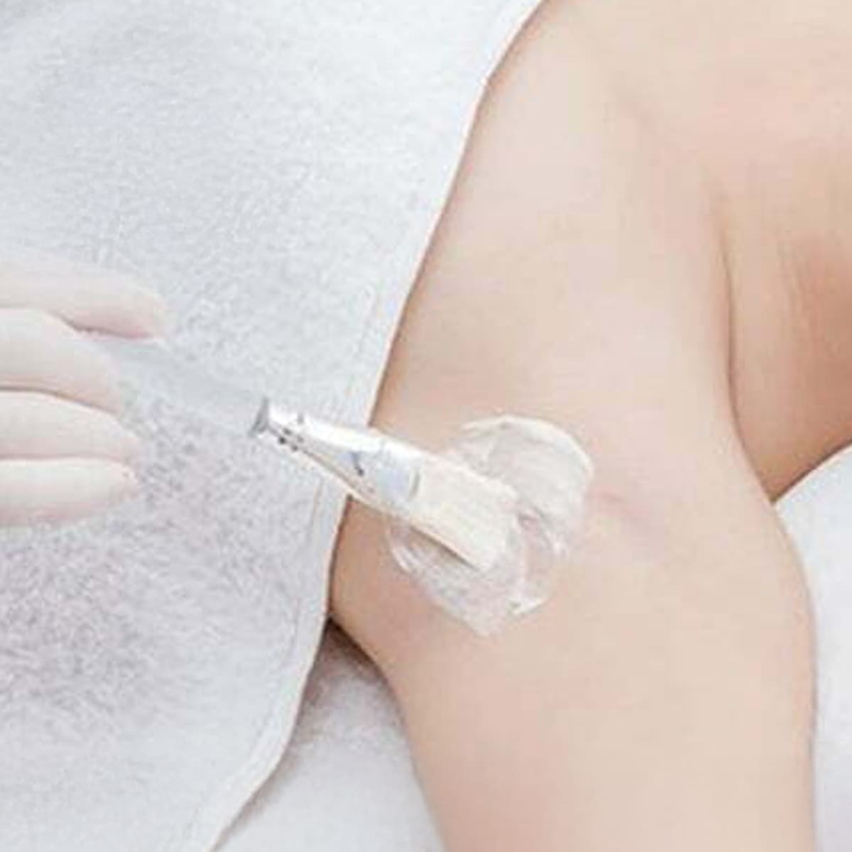 Khử thâm nách bằng phương pháp Peel da hóa học