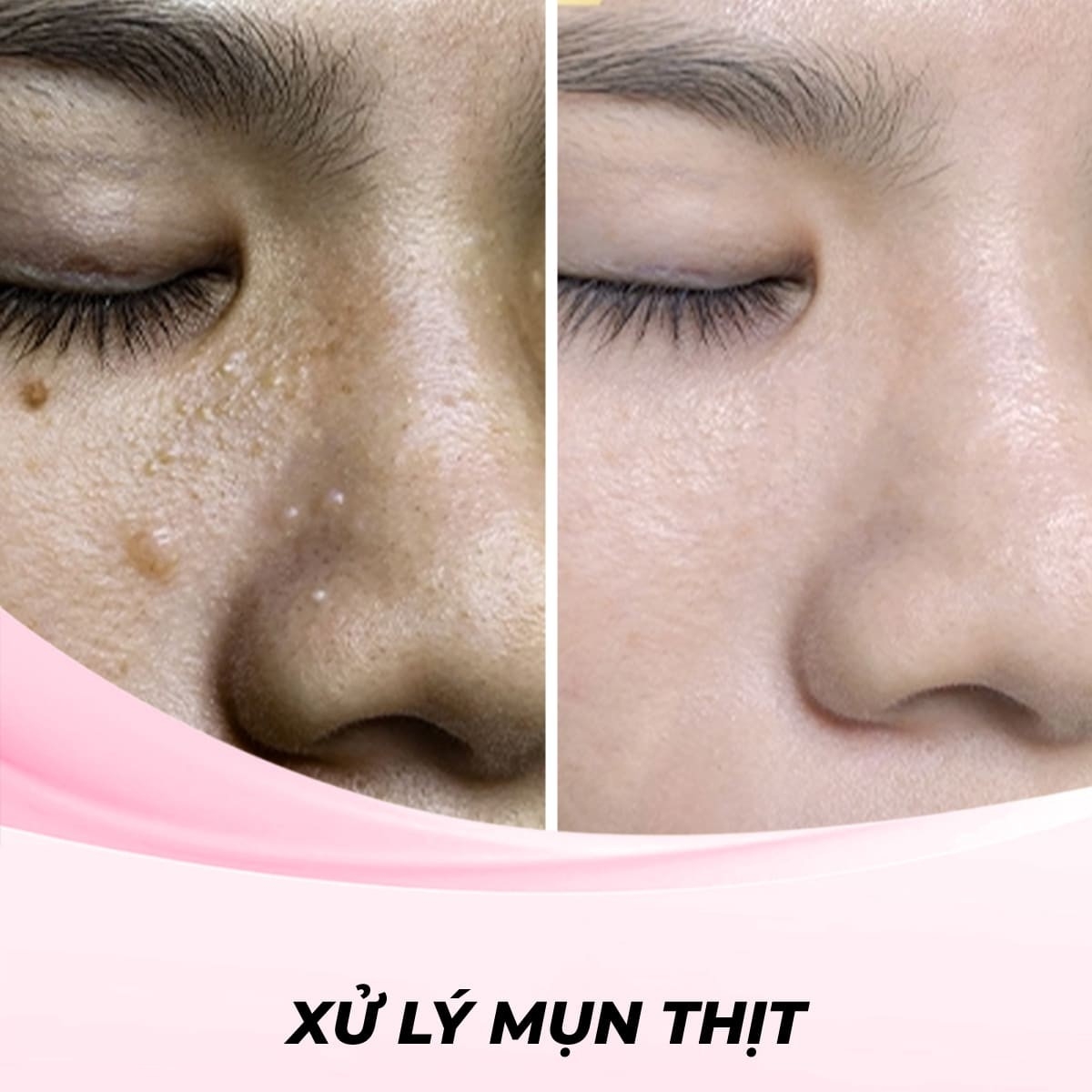 Xử lý mụn thịt - Phương pháp Cryotherapy (Liệu pháp lạnh)