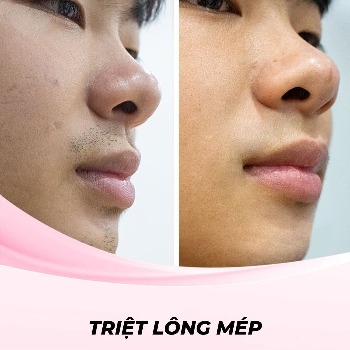 Triệt Lông Mép Bằng Phương Pháp Điện Di