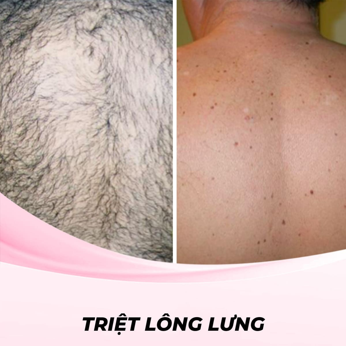 Triệt lông lưng bằng công nghệ IPL - Trải Nghiệm