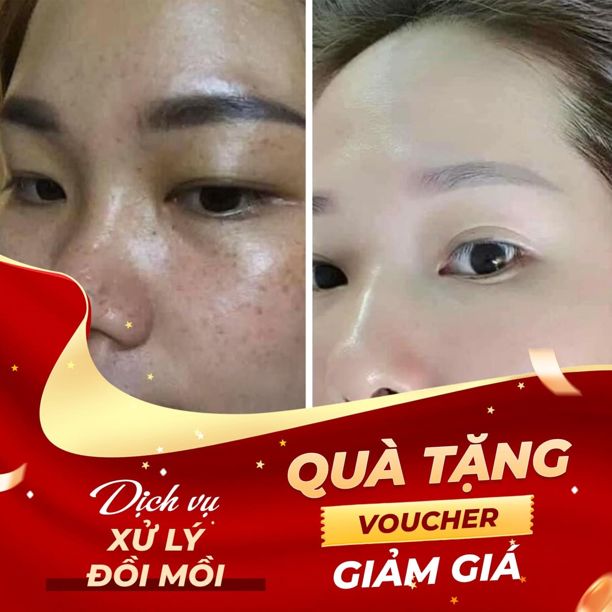 Tặng Voucher Dịch Vụ Xóa Đồi Mồi Bằng Tinh Chất Retinol - Trải nghiệm