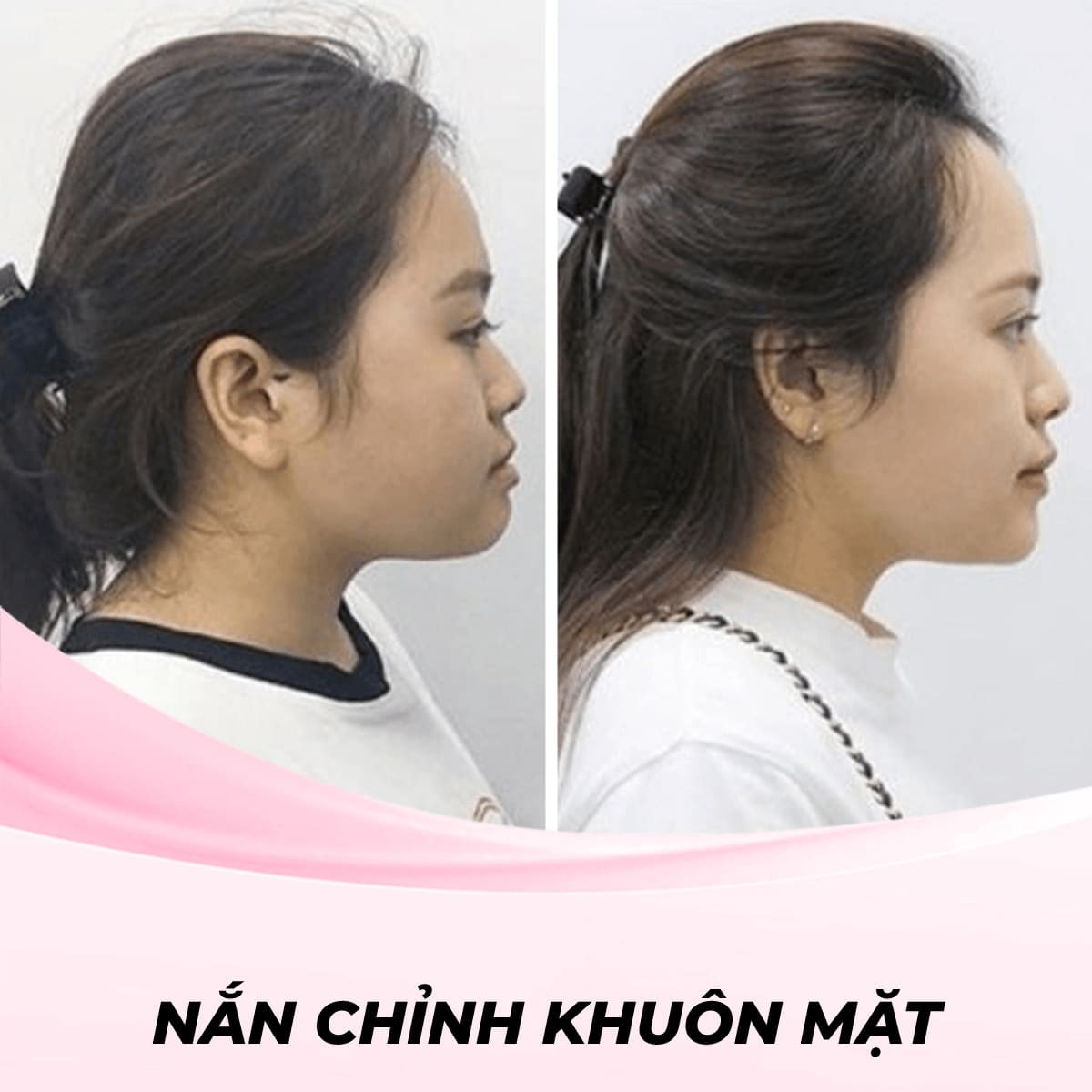 Dịch vụ nắn chỉnh khuôn mặt bằng phương pháp sóng siêu âm