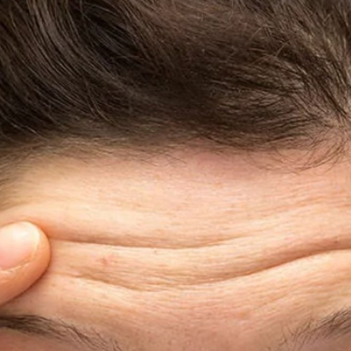 Làm đầy trán bằng Botox