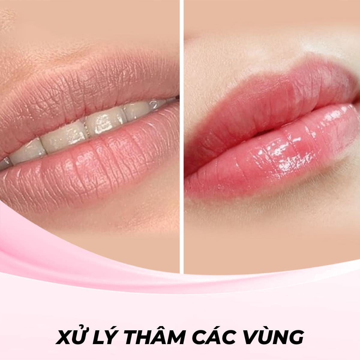 Xử lý Thâm Môi bằng phương pháp laser