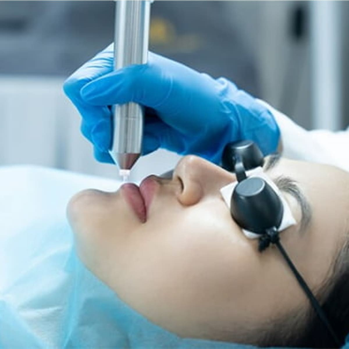 Xử lý Thâm Môi bằng phương pháp laser