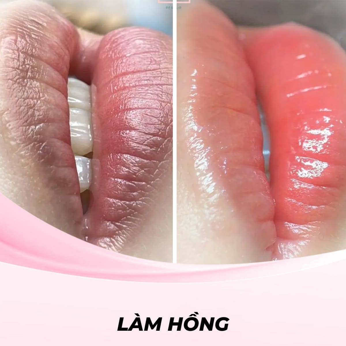 Làm hồng môi bằng Peeling hóa học