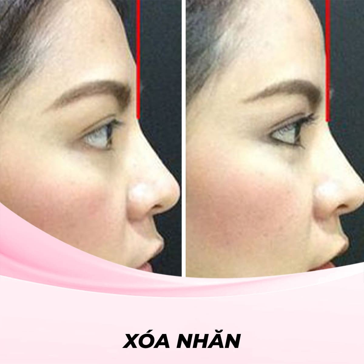 Làm đầy trán bằng Botox