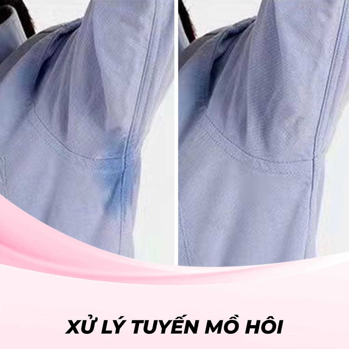 Xử lý tuyến mồ hôi nách bằng Botox