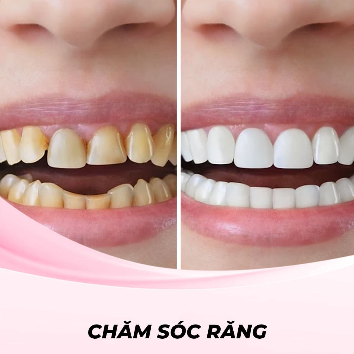 Tẩy trắng răng bằng đèn LED