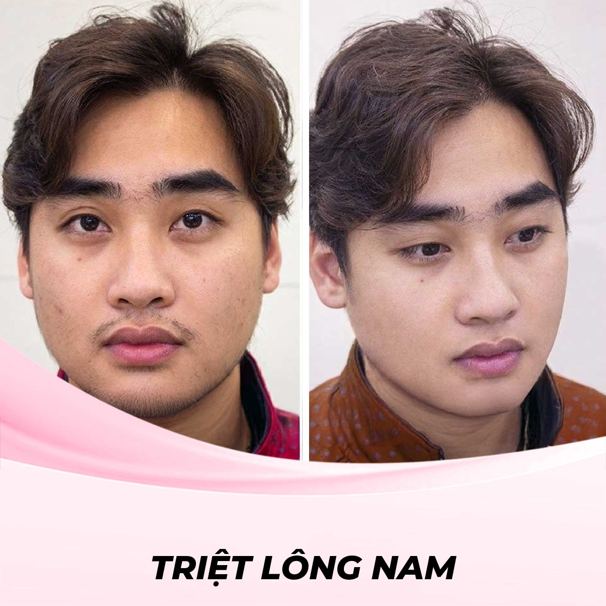 7 cách phân biệt máy triệt lông giả và thật chi tiết 11 Triệt Lông Mặt Cho Nam Bằng Điện Di